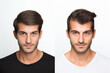 Leinwandbild Motiv Generative AI collage two photos comparison before after anti hair loss procedure hair treatment