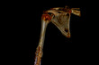 Cat Scan of Femur fracture frontal view. Medical themes