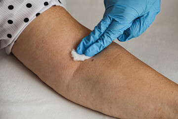 the moment after the patient's vaccination against the b.2.86 virus, a doctor wearing disposable blue gloves uses medical cotton wool to stop the flow of blood.