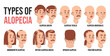 Types of alopecia infographic vector isolated. Illustration of people suffering from hair loss. Alopecia areata, totalis and universalis. Androgenetic and traction alopecia.