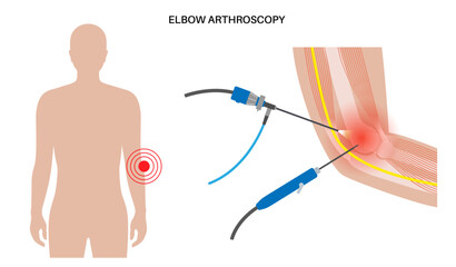 Poster - Elbow arthroscopy surgery