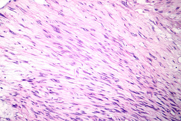 Poster - Leiomyosarcoma, light micrograph