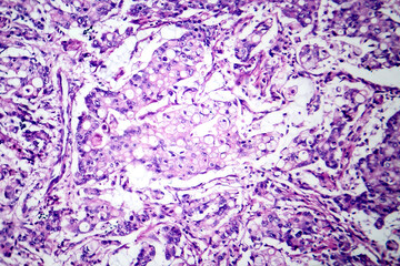 Sticker - Mucinous carcinoma in the stomach, light micrograph