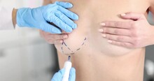 Nude Body Of Sexy Woman With Blue Surgical Markings On Chest. Plastic Surgery Concept