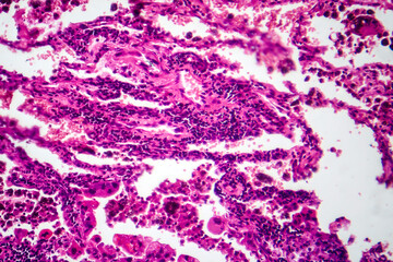 Poster - Lung cancer tissue, light micrograph