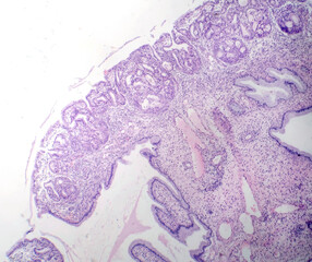 Sticker - Nasal polyps, light micrograph