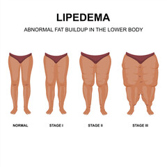 Lipedema vector stages and symptoms