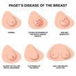 Pagets disease of the breast illustration