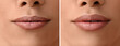© Pixel-Shot - Young transgender woman before and after lip enhancement, closeup