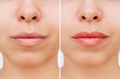 © Марина Демешко - Result of lip tattooing. Cropped shot of young woman's lower part of face with lips before and after permanent makeup. Changing brightness and volume. Clear outline. Cosmetology and beauty concept