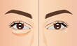 Compare of puffy eye bag of woman's face before and after surgery, illustration