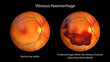 Vitreous hemorrhage as observed during ophthalmoscopy, 3D illustration