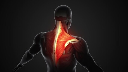 Canvas Print - Pain and injury in the Trapezius muscles