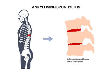 Canvas Print - Ankylosing spondylitis disease