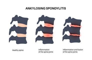 Wall Mural - Ankylosing spondylitis disease