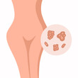 Vector isolated illustration of genital herpes in women. Rash of genital herpes.