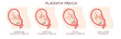 前置胎盤、placenta previa、illustration
