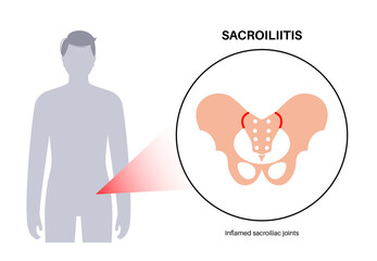 Wall Mural - Sacroiliitis medical poster