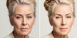 Woman face wrinkles before and after treatment