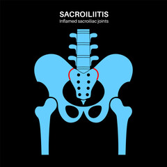 Sticker - Sacroiliitis medical poster