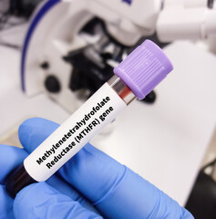 Canvas Print - Blood sample for Methylenetetrahydrofolate Reductase (MTHFR) variant or MTHFR mutation test, to Hyperhomocysteinemia.