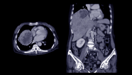 CT upper abdomen DDX is atypical HCC or hepatocellular carcinoma.