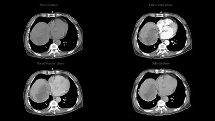 CT upper abdomen axial view  NC, A phase , V phase and delayed phase DDX is atypical HCC or hepatocellular carcinoma.