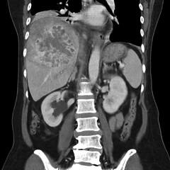 CT upper abdomen coronal view showing  DDX is atypical HCC or hepatocellular carcinoma.