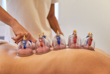 Therapist checking patient spine during cupping treatment. Healthcare suction massage on the spa