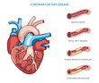 Coronary artery disease is a condition where the coronary arteries become narrowed or blocked, reducing blood flow to the heart and increasing the risk of heart attacks and other cardiovascular compli