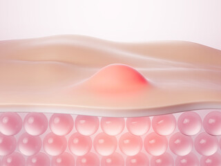 acne skin layer, Skin treatments , cosmetology and skincare problems. 3d rendering.
