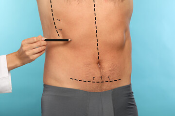 Poster - Man preparing for cosmetic surgery, light blue background. Doctor drawing markings on his abdomen, closeup