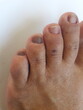 Unha do pé de pessoa com hipotireoidismo calosidades, micose, pele seca e desidratada