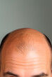 © henjon - Male hairloss or baldness, top down view of a man with a bald spot on his head. Shallow field of view and copy space.