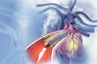 Balloon angioplasty procedure with stent in vein.3d illustration