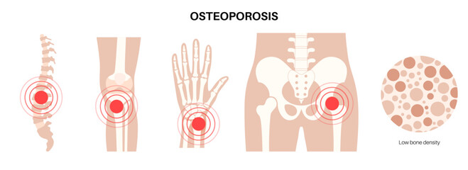 Wall Mural - Osteoporosis medical poster