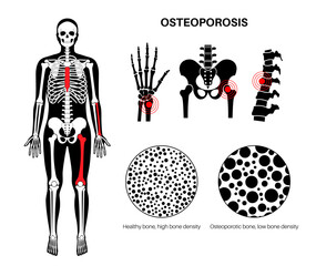 Canvas Print - Osteoporosis medical poster