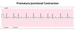 ECG Premature Junctional Contraction - 8 Second ECG Paper - Electrocardiogram Vector Medical Illustration