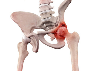 Skeleton with osteoarthritis hip joint injury