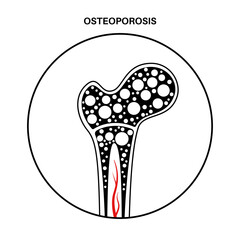 Canvas Print - Osteoporosis medical poster