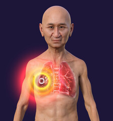 Poster - A man with the lungs affected by cavernous tuberculosis, 3D illustration