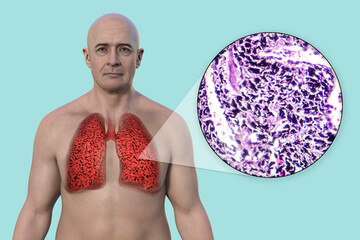 Sticker - A man with smoker's lungs, 3D illustration and micrograph