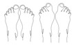 Valgus deformity of the foot. One line