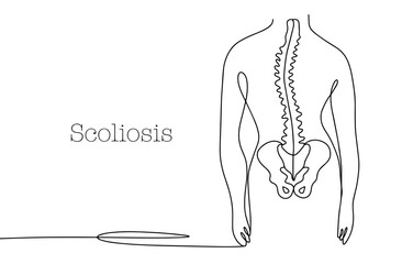 Wall Mural - Scoliosis. Human. Spine. Rachiocampsis. One line