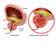 Medical illustration showing Benign prostatic hyperplasia BPH and Normal prostate. Prostate gland enlargement