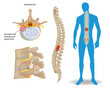 Spinal Disc Herniation. Back Pain Human. Spinal Cord Compression. Bulging disc.