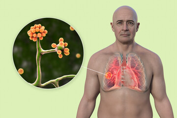 Poster - A man with lung mucormycosis lesion, and close-up view of Cunninghamella bertholletiae fungi, 3D illustration