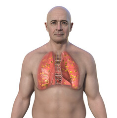 Poster - Lung histoplasmosis, a fungal infection caused by Histoplasma capsulatum, 3D illustration