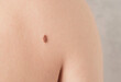 Close-up of a mole on a person's back. Skin Cancer Awareness Month