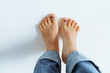 barefoot female feet with bruise on big toe nail due to tight uncomfortable shoes on white background
